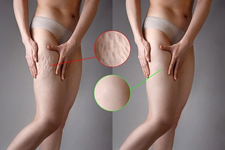 eliminer la cellulite