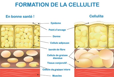 Formation de la cellulite