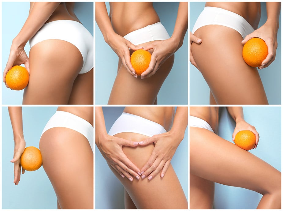 cellulite peau d'orange