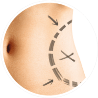 Cryolipolyse zones traitées